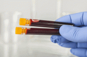 Kan Testi Erken Pankreas Kanseri Bulmasına Yardımcı Olur