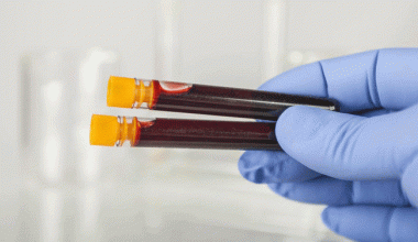 Kan Testi Erken Pankreas Kanseri Bulmasına Yardımcı Olur