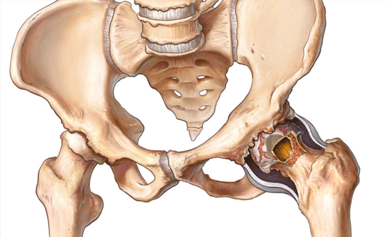 Kalça Protezi Ameliyatı Nedir?