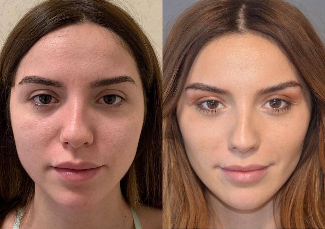 Sssniperwolf Before And After Surgery