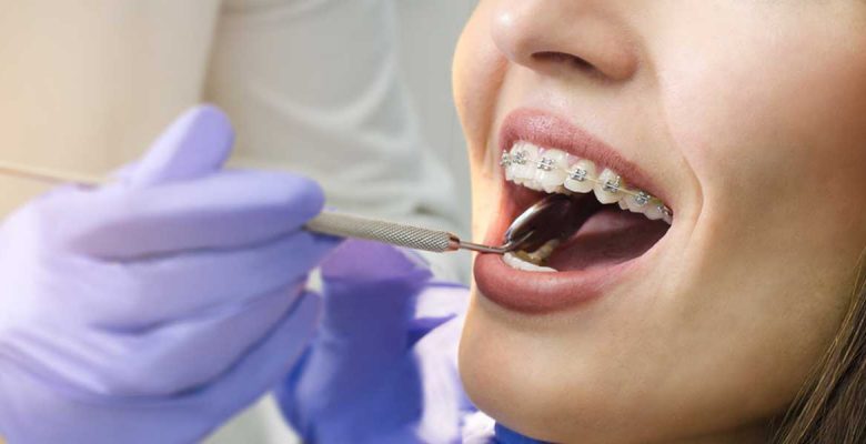 Diş Teli Tedavisi Nasıl Uygulanır?