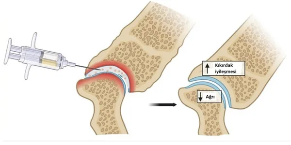 Eksozom Diz Tedavisi Etkileri Nelerdir?